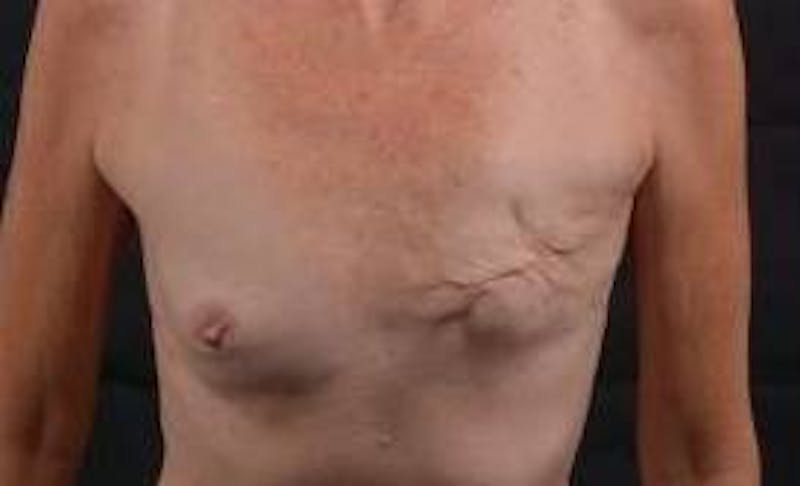 Delayed Breast Reconstruction Before & After Gallery - Patient 320892 - Image 1