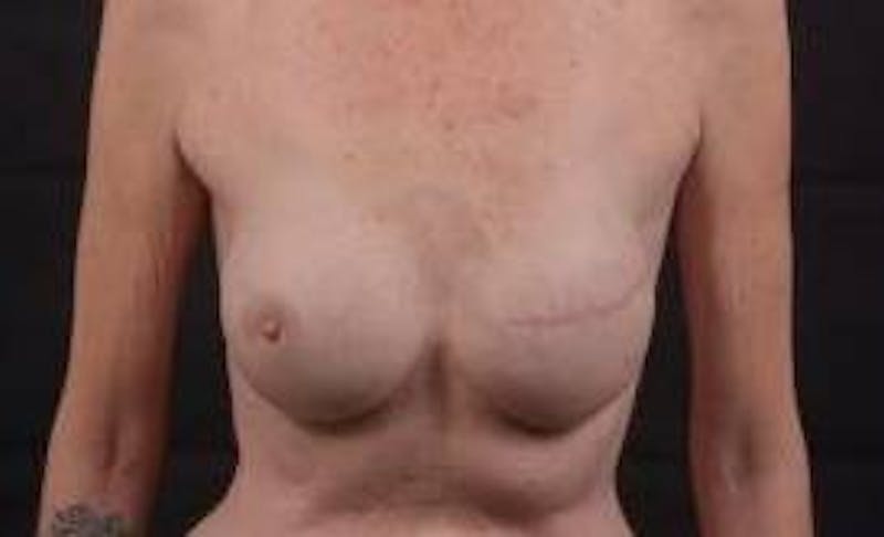 Delayed Breast Reconstruction Before & After Gallery - Patient 320892 - Image 2