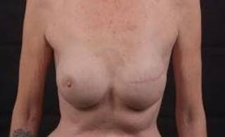 Delayed Breast Reconstruction Before & After Gallery - Patient 320892 - Image 2