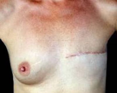 Delayed Breast Reconstruction Before & After Gallery - Patient 327623 - Image 1