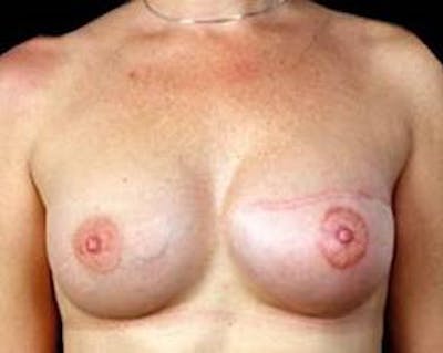 Delayed Breast Reconstruction Before & After Gallery - Patient 327623 - Image 2