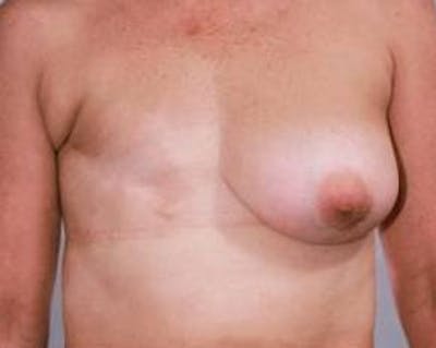 Delayed Breast Reconstruction Before & After Gallery - Patient 304123 - Image 1