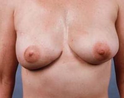 Delayed Breast Reconstruction Before & After Gallery - Patient 304123 - Image 2