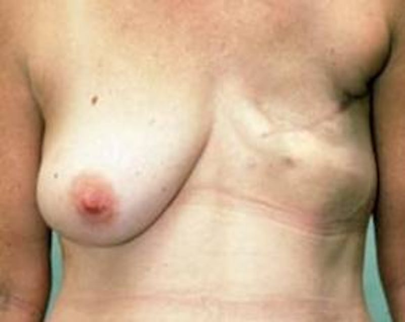 Delayed Breast Reconstruction Before & After Gallery - Patient 888826 - Image 1