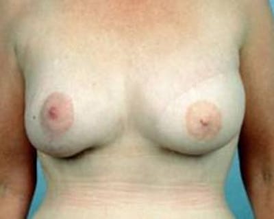 Delayed Breast Reconstruction Before & After Gallery - Patient 888826 - Image 2