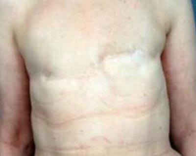 Delayed Breast Reconstruction Before & After Gallery - Patient 210730 - Image 1