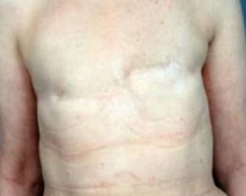 Delayed Breast Reconstruction Before & After Gallery - Patient 210730 - Image 1