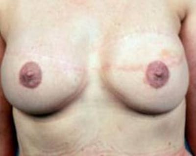 Delayed Breast Reconstruction Before & After Gallery - Patient 210730 - Image 2
