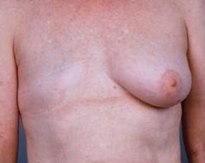 Delayed Breast Reconstruction Before & After Gallery - Patient 139807 - Image 1