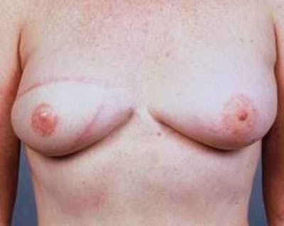 Delayed Breast Reconstruction Before & After Gallery - Patient 139807 - Image 2