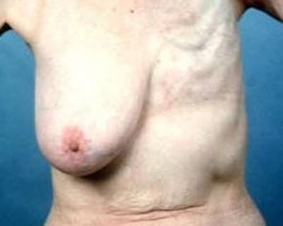 Delayed Breast Reconstruction Before & After Gallery - Patient 241709 - Image 1