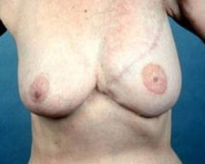 Delayed Breast Reconstruction Before & After Gallery - Patient 241709 - Image 2