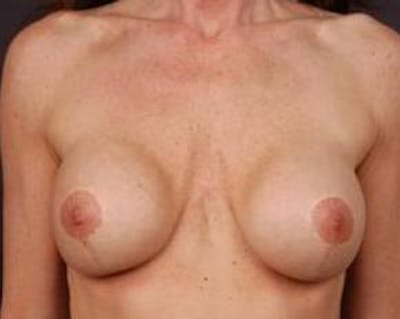 Immediate Breast Reconstruction – Flaps Before & After Gallery - Patient 371009 - Image 1