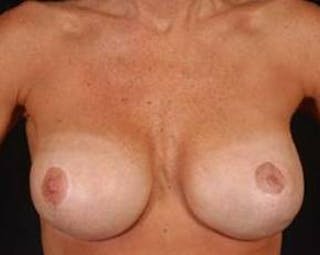 Immediate Breast Reconstruction – Flaps Before & After Gallery - Patient 371009 - Image 2