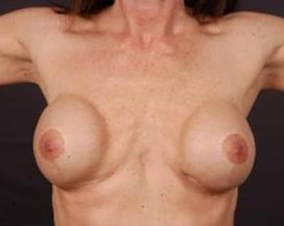 Immediate Breast Reconstruction – Flaps Before & After Gallery - Patient 413156 - Image 1