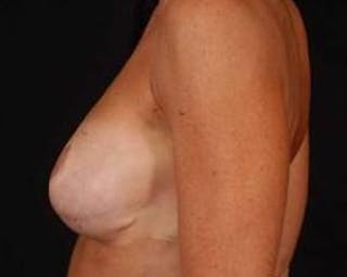 Immediate Breast Reconstruction – Flaps Before & After Gallery - Patient 413156 - Image 4