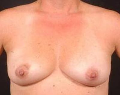 Immediate Breast Reconstruction – Flaps Before & After Gallery - Patient 352908 - Image 1