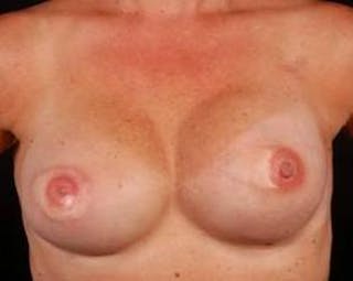 Immediate Breast Reconstruction – Flaps Before & After Gallery - Patient 352908 - Image 2