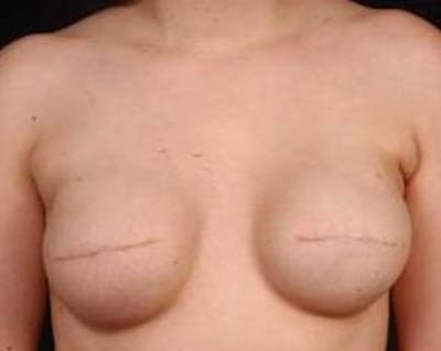 Immediate Breast Reconstruction – Flaps Before & After Gallery - Patient 264346 - Image 1