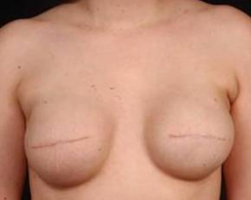 Immediate Breast Reconstruction – Flaps Before & After Gallery - Patient 264346 - Image 1