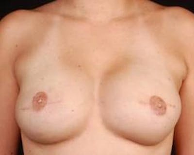 Immediate Breast Reconstruction – Flaps Before & After Gallery - Patient 264346 - Image 2