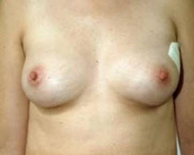 Immediate Breast Reconstruction – Flaps Before & After Gallery - Patient 183227 - Image 1