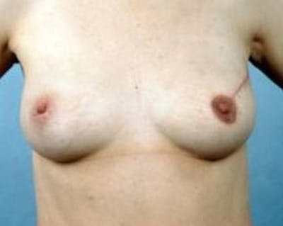 Immediate Breast Reconstruction – Flaps Before & After Gallery - Patient 183227 - Image 2