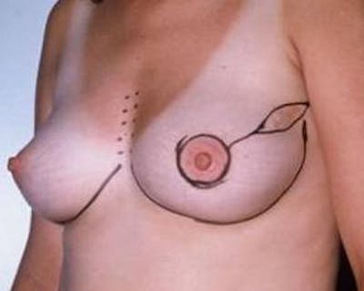 Immediate Breast Reconstruction – Flaps Before & After Gallery - Patient 576937 - Image 1