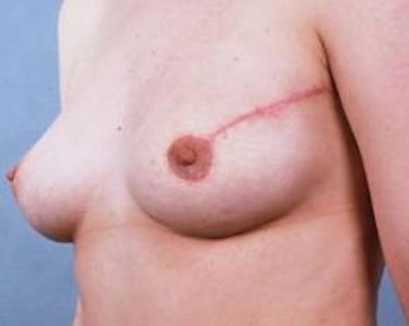 Immediate Breast Reconstruction – Flaps Before & After Gallery - Patient 576937 - Image 2