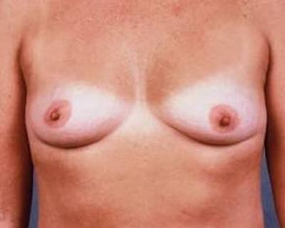 Immediate Breast Reconstruction – Flaps Before & After Gallery - Patient 655918 - Image 1