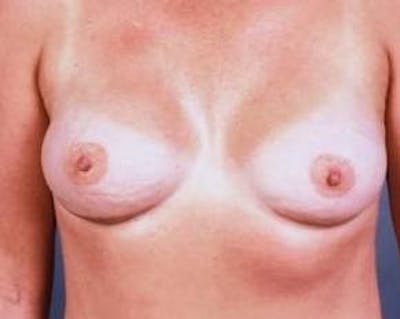 Immediate Breast Reconstruction – Flaps Before & After Gallery - Patient 655918 - Image 2
