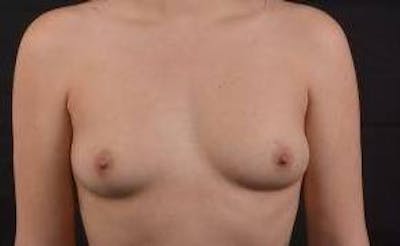 Immediate Breast Reconstruction – Nipple Sparing Before & After Gallery - Patient 385996 - Image 1