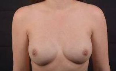 Immediate Breast Reconstruction – Nipple Sparing Before & After Gallery - Patient 385996 - Image 2