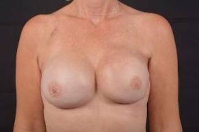 Immediate Breast Reconstruction – Nipple Sparing Before & After Gallery - Patient 205430 - Image 2