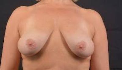 Immediate Breast Reconstruction – Nipple Sparing Before & After Gallery - Patient 119864 - Image 1