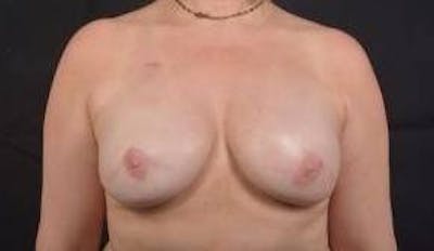Immediate Breast Reconstruction – Nipple Sparing Before & After Gallery - Patient 119864 - Image 2