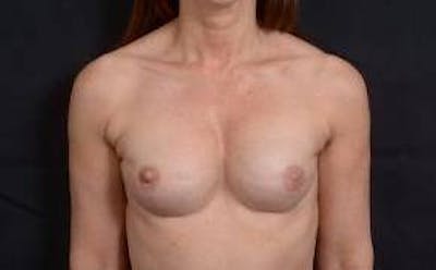 Immediate Breast Reconstruction – Nipple Sparing Before & After Gallery - Patient 938885 - Image 1