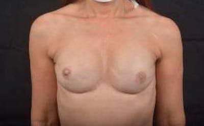 Immediate Breast Reconstruction – Nipple Sparing Before & After Gallery - Patient 938885 - Image 2