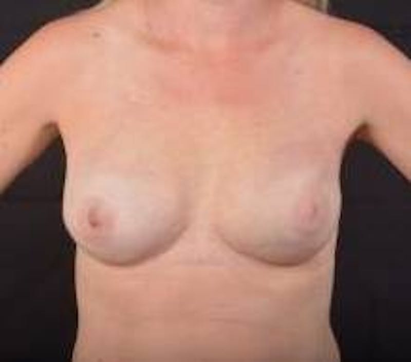 Immediate Breast Reconstruction – Nipple Sparing Before & After Gallery - Patient 410683 - Image 2
