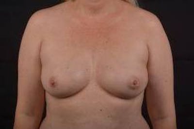Immediate Breast Reconstruction – Nipple Sparing Before & After Gallery - Patient 420434 - Image 1