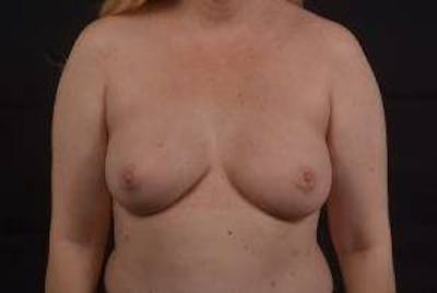 Immediate Breast Reconstruction – Nipple Sparing Before & After Gallery - Patient 420434 - Image 2