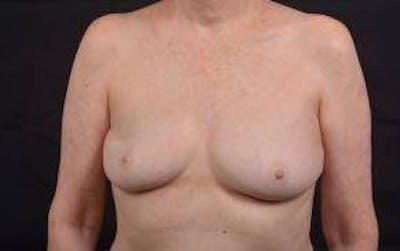 Immediate Breast Reconstruction – Nipple Sparing Before & After Gallery - Patient 351464 - Image 1