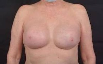 Immediate Breast Reconstruction – Nipple Sparing Before & After Gallery - Patient 351464 - Image 2