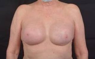 Immediate Breast Reconstruction – Nipple Sparing Before & After Gallery - Patient 351464 - Image 2