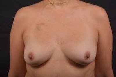 Immediate Breast Reconstruction – Nipple Sparing Before & After Gallery - Patient 299525 - Image 1
