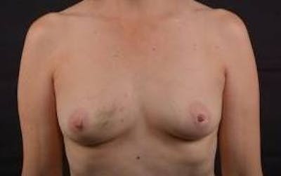 Immediate Breast Reconstruction – Nipple Sparing Before & After Gallery - Patient 317102 - Image 1