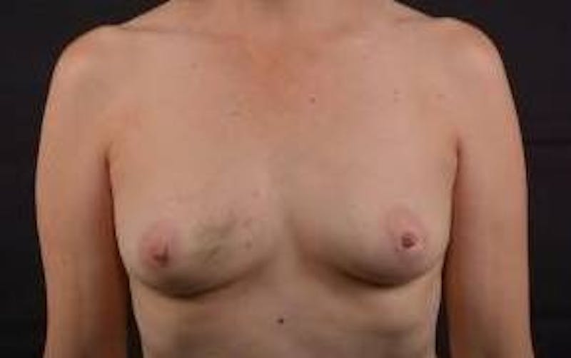 Immediate Breast Reconstruction – Nipple Sparing Before & After Gallery - Patient 317102 - Image 1