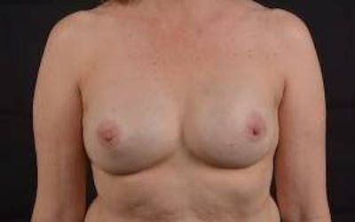 Immediate Breast Reconstruction – Nipple Sparing Before & After Gallery - Patient 317102 - Image 2