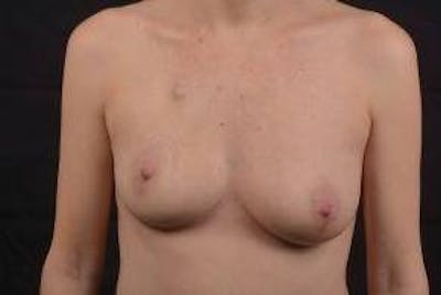 Immediate Breast Reconstruction – Nipple Sparing Before & After Gallery - Patient 783210 - Image 1