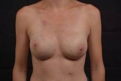 Immediate Breast Reconstruction – Nipple Sparing Before & After Gallery - Patient 783210 - Image 2
